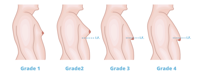 Gynecomastia-grades