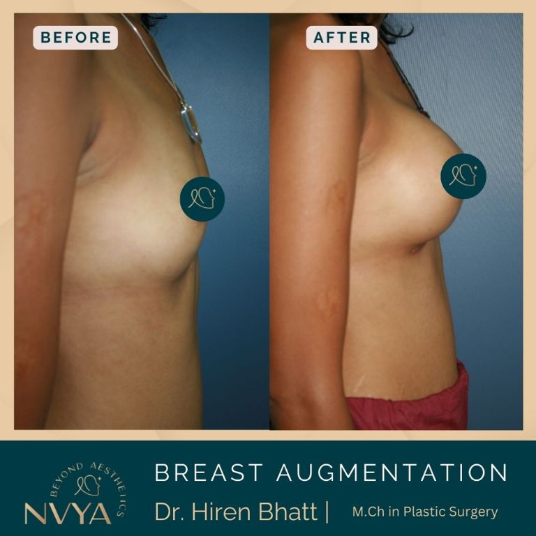 Before and after results of breast augmentation surgery