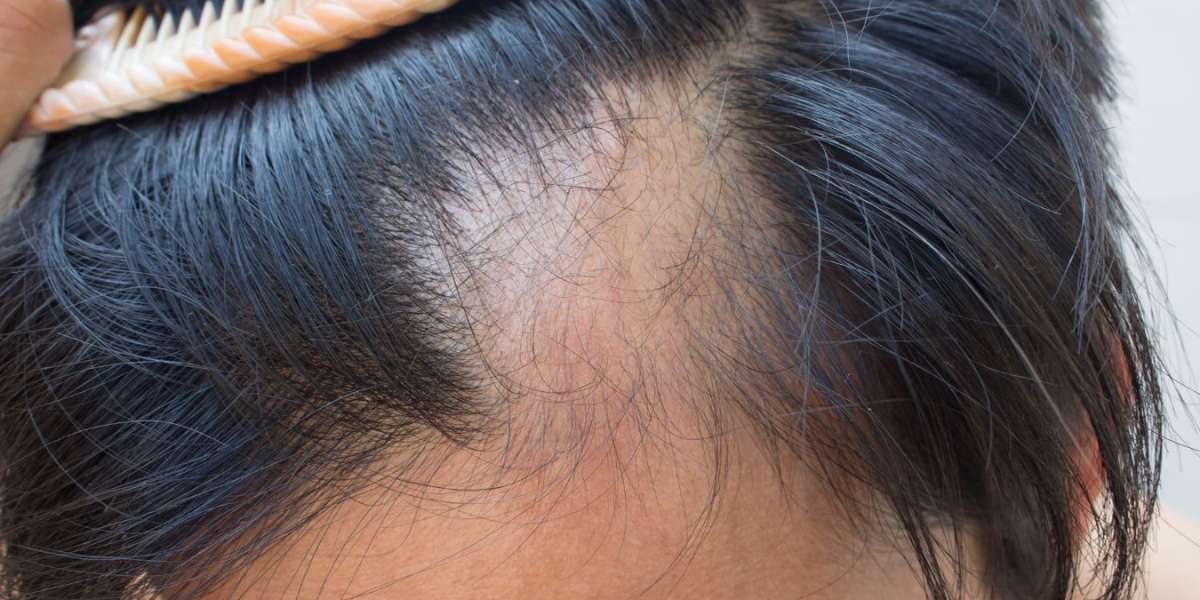 Choosing the Right Hair Loss Treatment