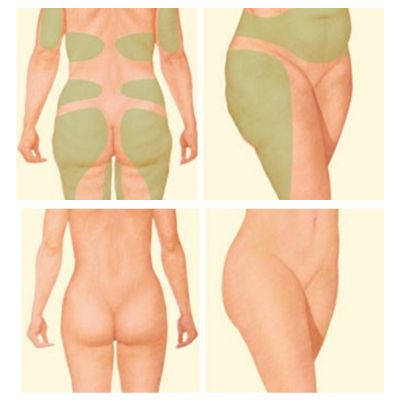 Liposuction on Thighs, Hips, Buttocks, Waist, Back, Upper Arms, and Inner Knees (representative)