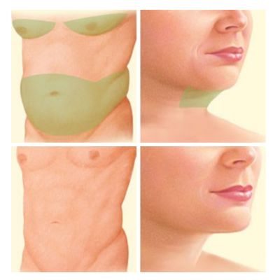 Liposuction on Cheeks, Chin and Neck, Chest area, Abdomen (representative)