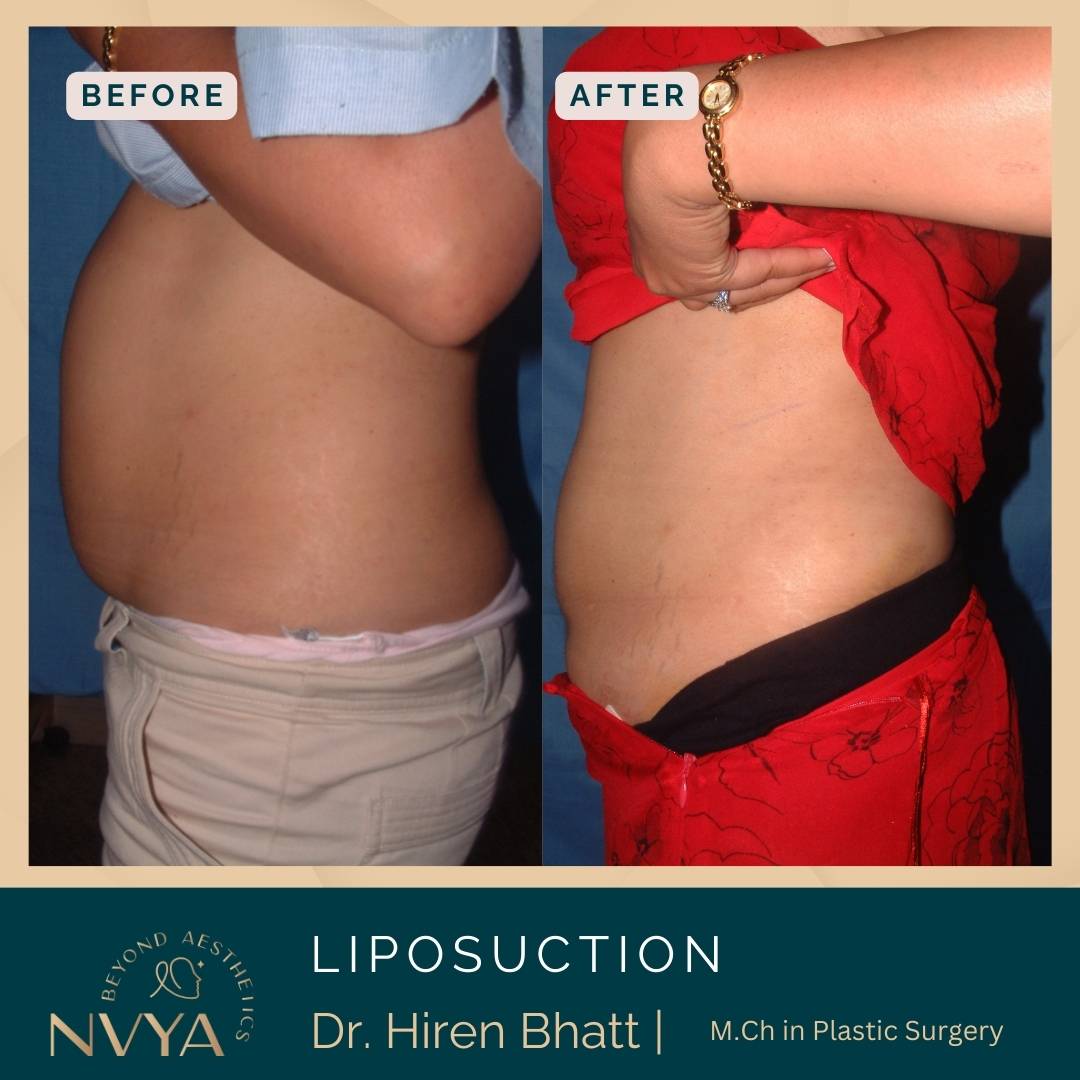 Liposuction before and after Side view