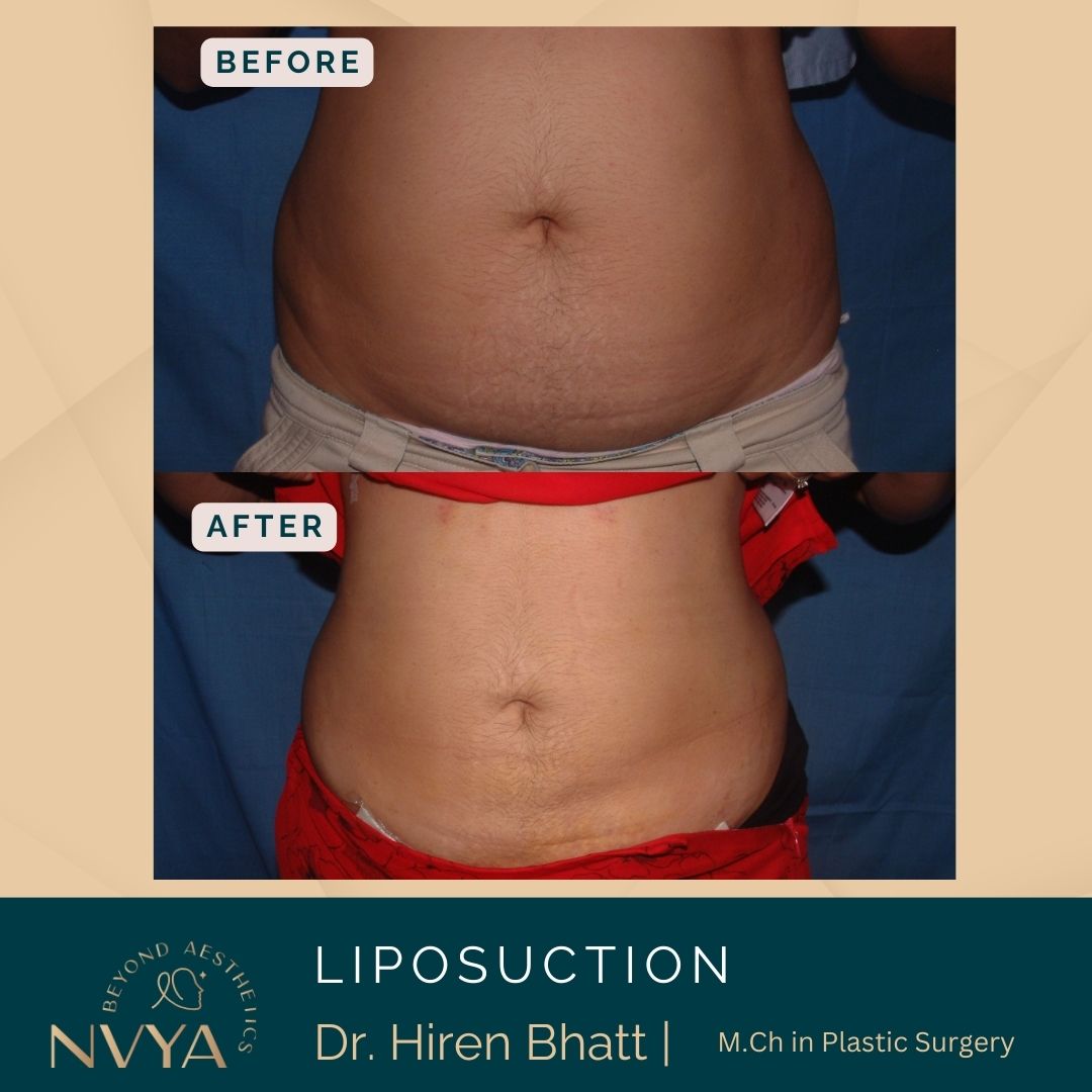 Liposuction before and after Front view