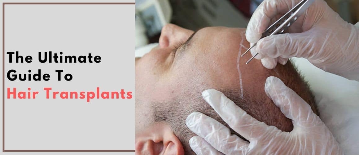 The Ultimate Guide To Hair Transplants