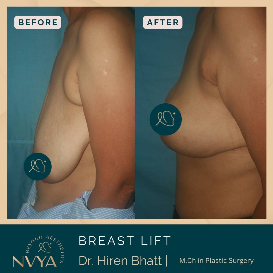 before-and-after-images-after-breast-lift surgery