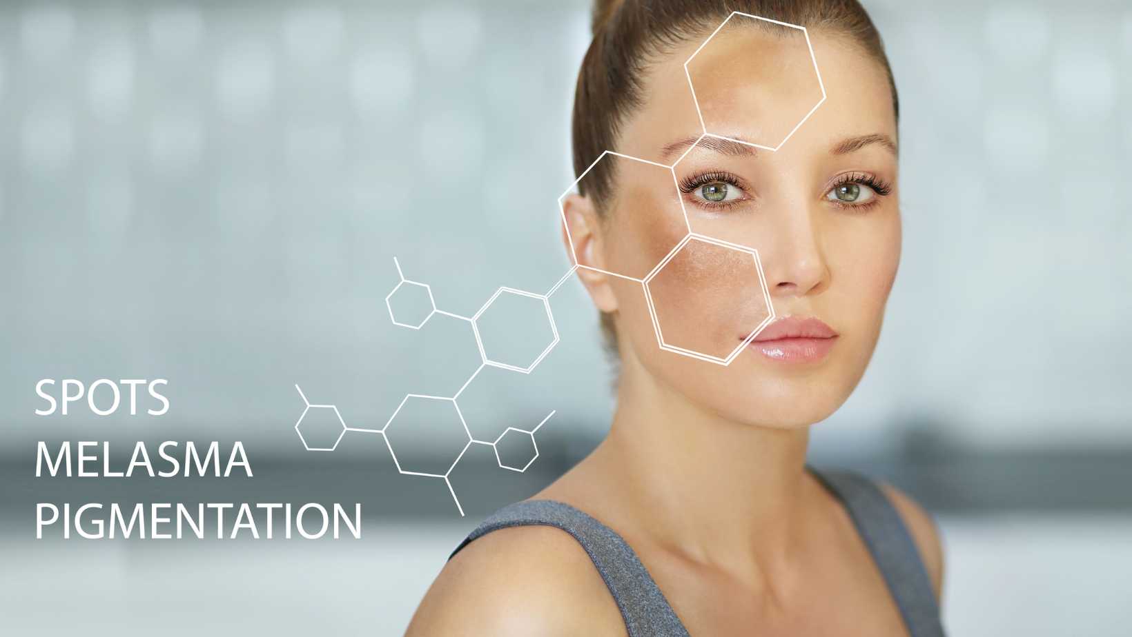 Fight Pigmentation Effectively with Hollywood Spectra Laser