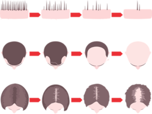 Stages of Alopecia