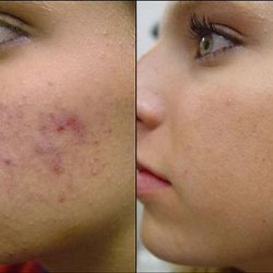 /images/services/acne/before-after-acne.jpg