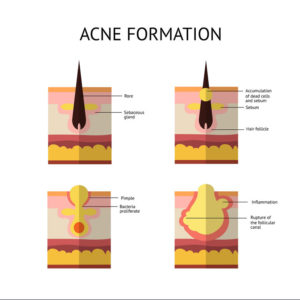 Formation of skin acne or pimple