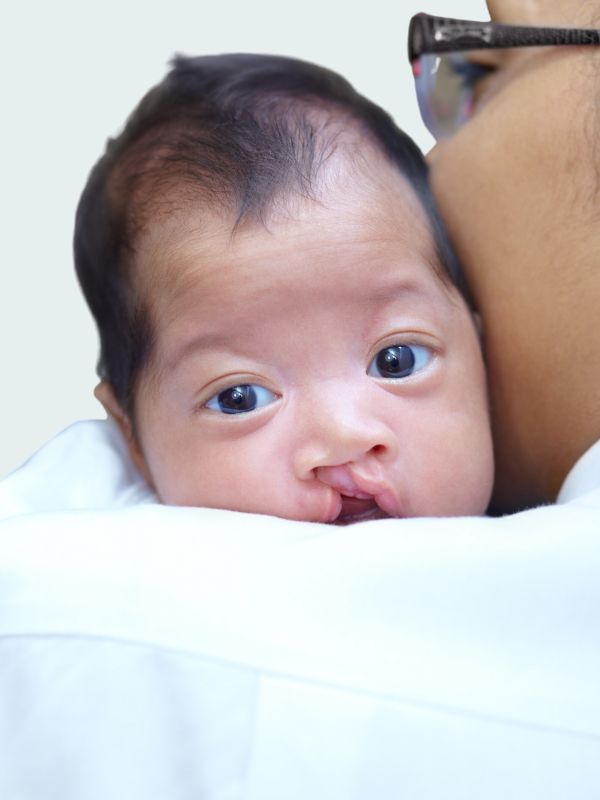 cleft-lip-and-cleft-palate
